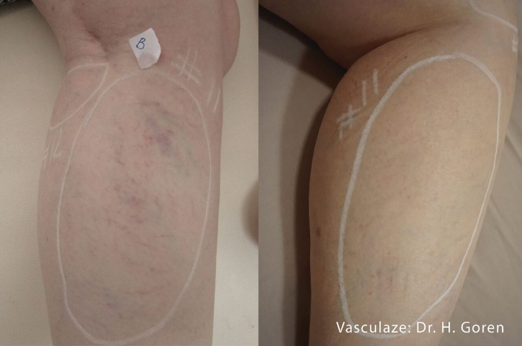 HG Vasculaze 1tx 2 Passes Legs Preview